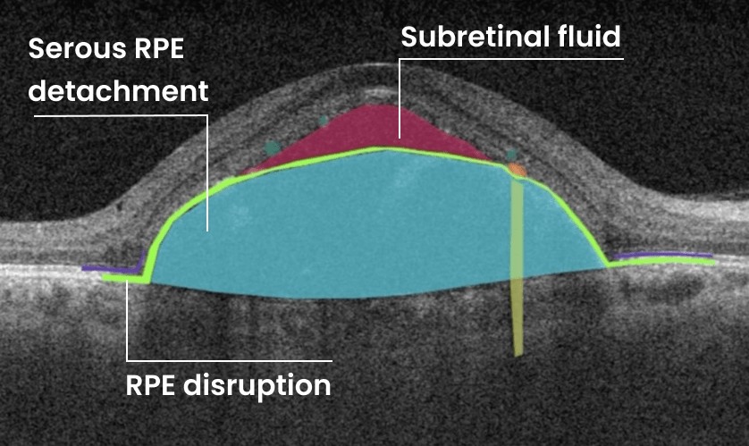 AI-powered software for eye care offices